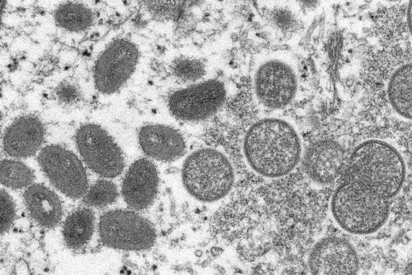 Hawaii Health Department reports 2 more monkeypox cases, bringing total to 18